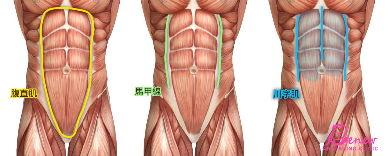 【川字肌腹部拉皮】腹部拉皮 | 一露肚成万人迷!