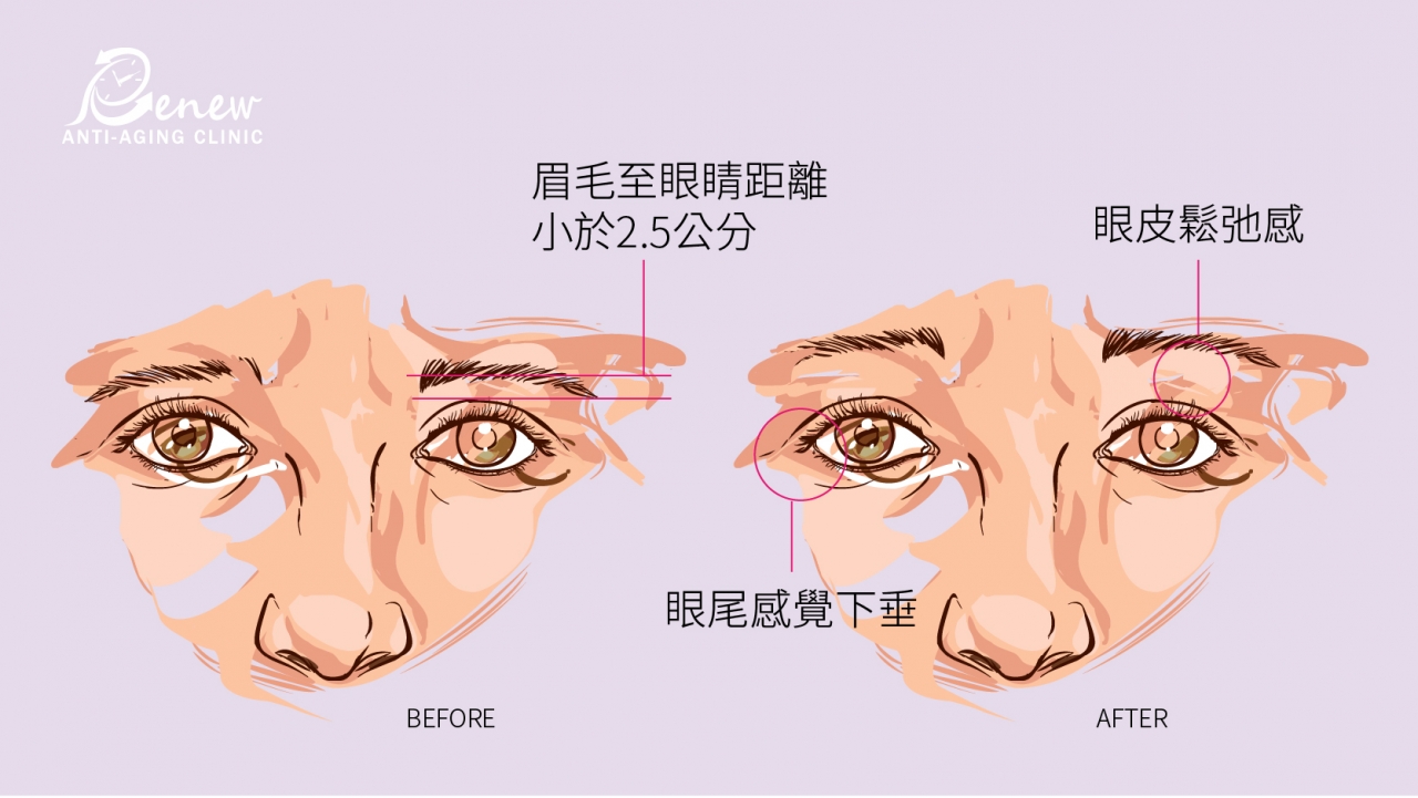 æçœ‰çœ¼éš±ç—•æ‹‰çš®ï¼šæ“ºè„«å€’çœ‰åž‚çœ¼å•é¡Œï¼Œå›žæ­¸ã€Œäº®çœ¼ã€ç¾Žäººå¯¶åº§